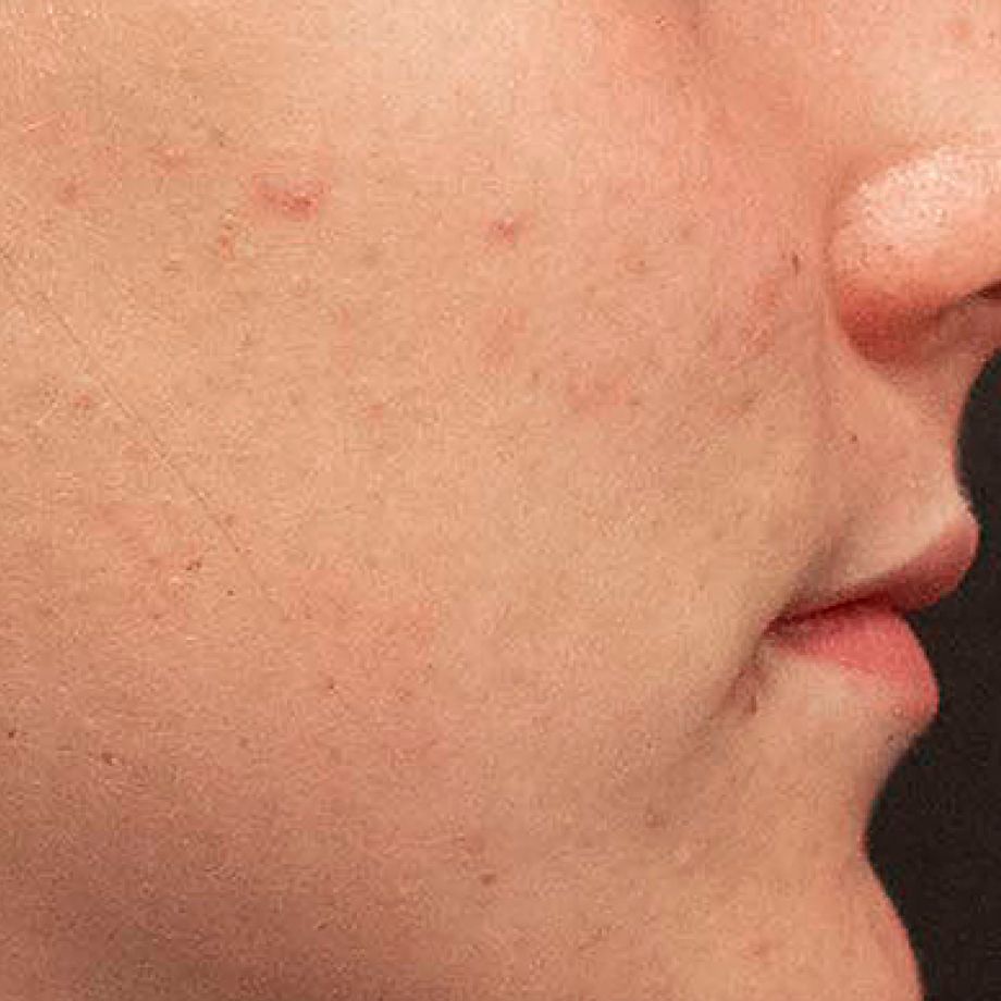 after madara acne line products use