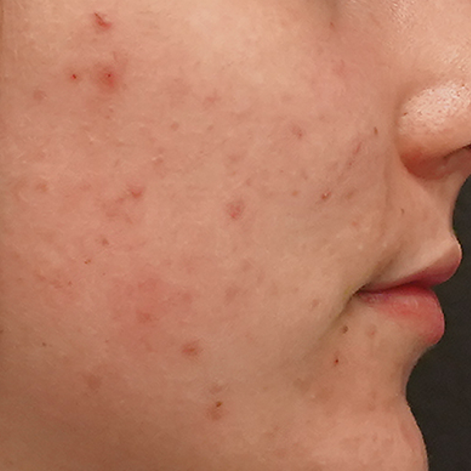 before madara acne line products use