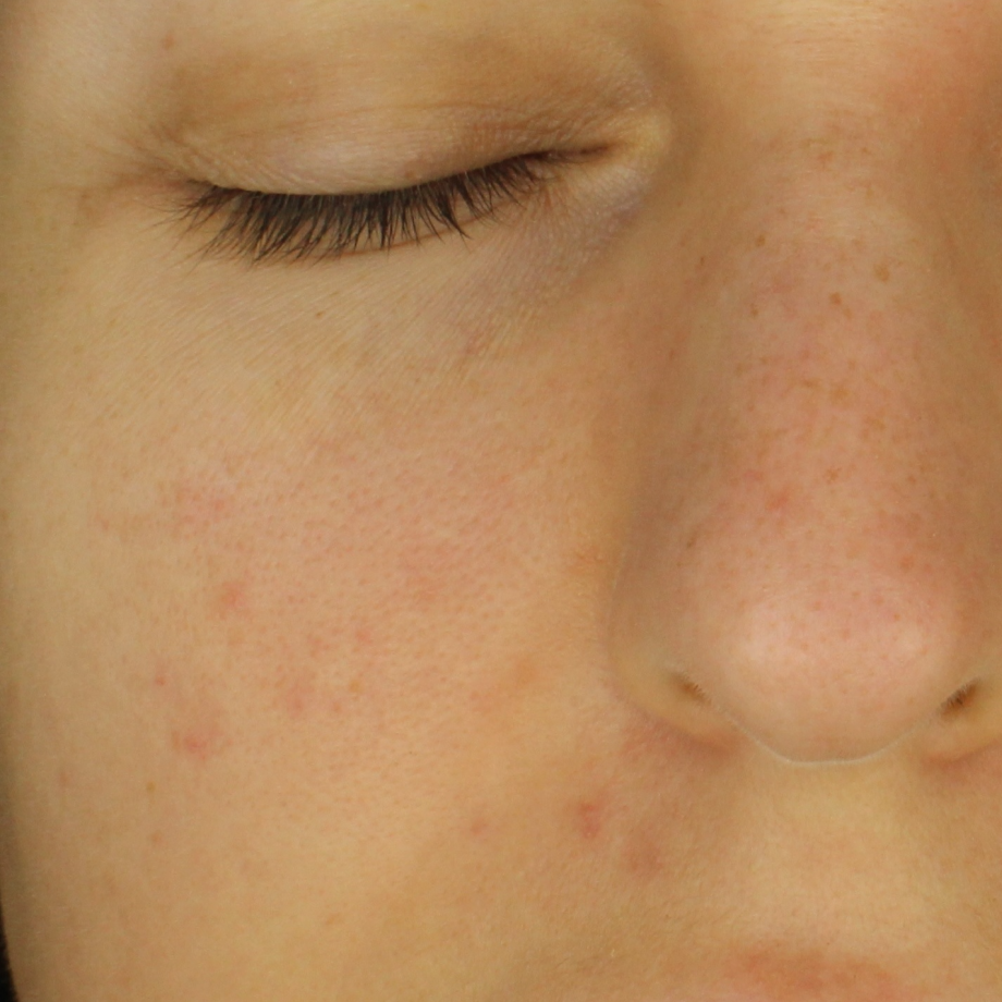 close-up of womans face after using Madara Niacinamide Alternative 5-in-1 Serum