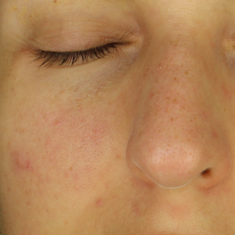 close-up of womans face before using Madara Niacinamide Alternative 5-in-1 Serum