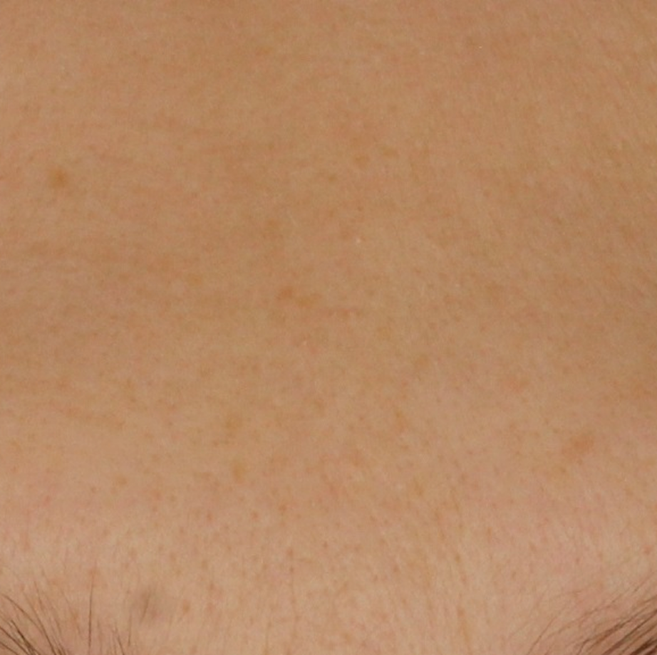 close-up of womans forehead after using Madara retinol alternative day cream