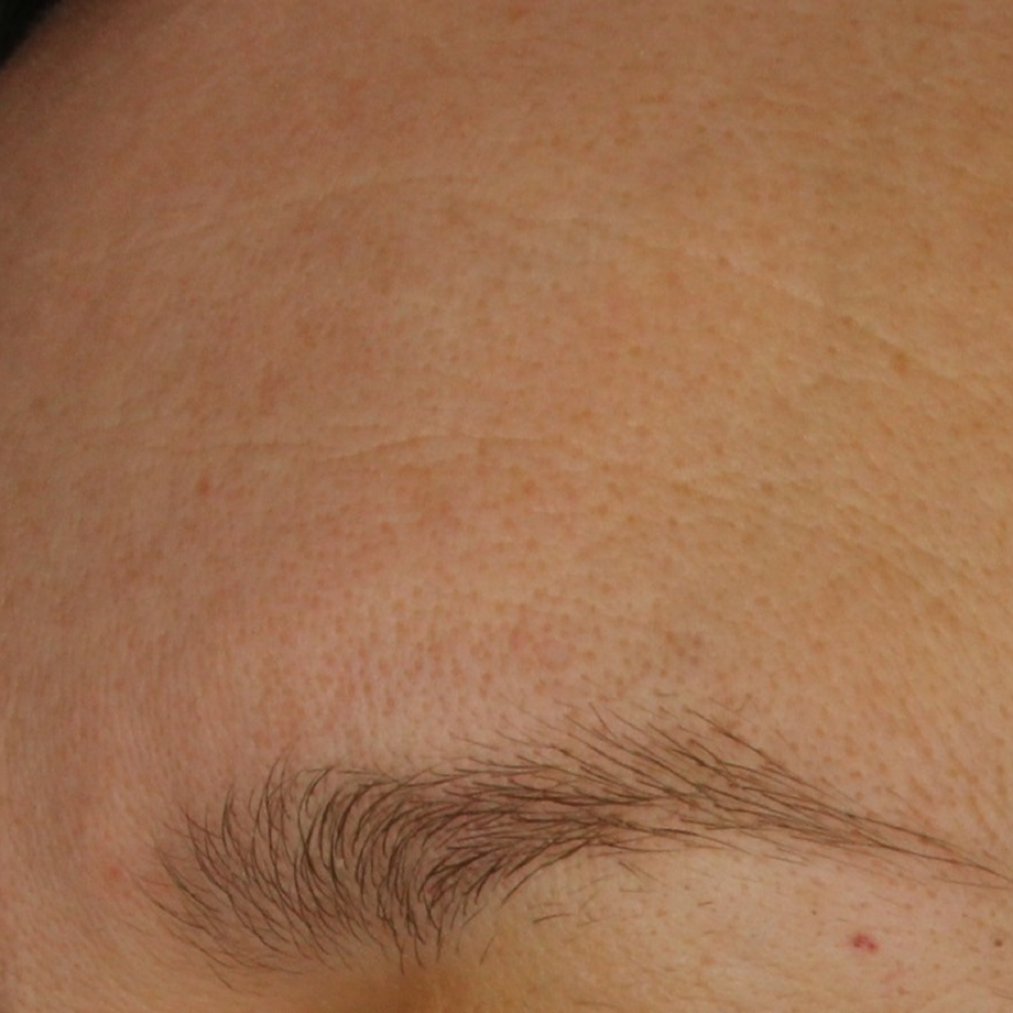 close-up of womans forehead before using Madara retinol alternative night cream