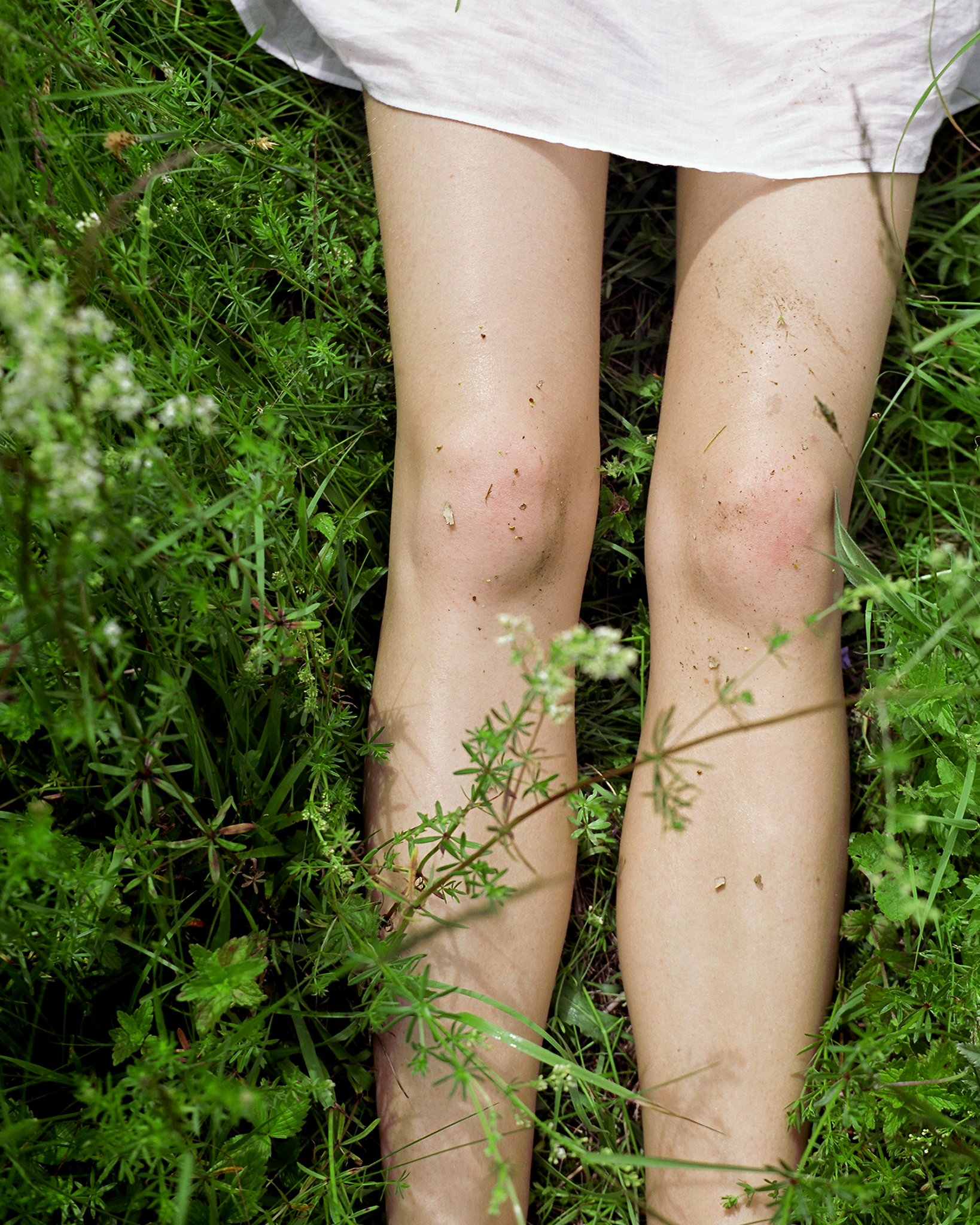 Close-up of legs with visible insect bites on grass